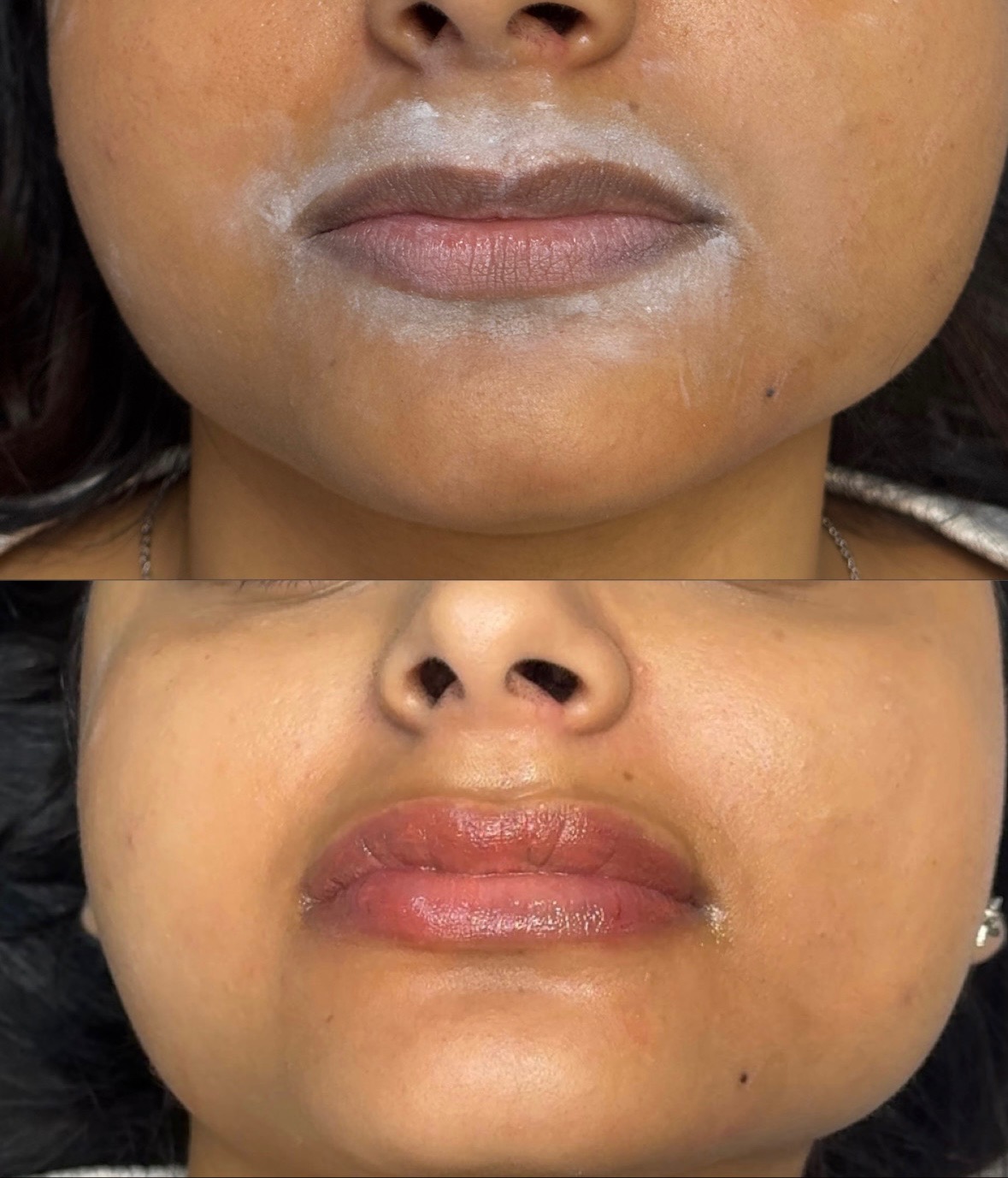 Lip Neutralization Before and After